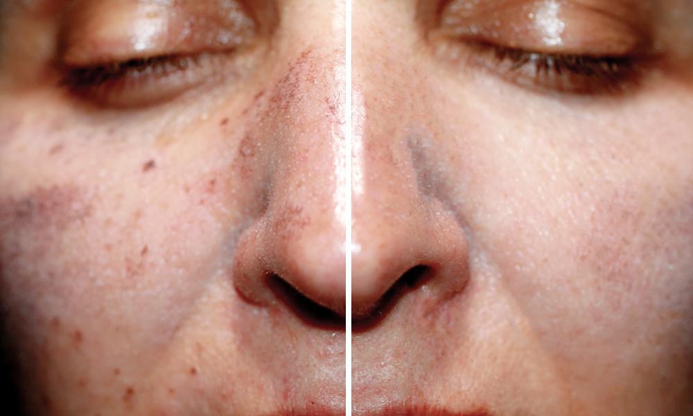 See Dark Spots Go With PicoSure Laser Skin Rejuvenation Orange Coast 