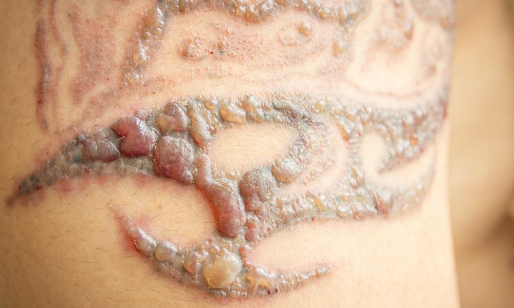 Keloid scars recognition and management  The Pharmaceutical Journal
