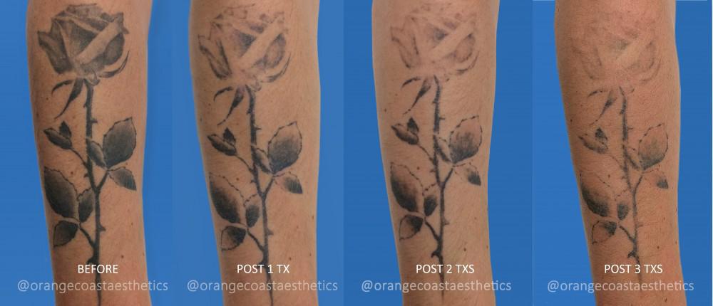 How to Care for Skin After Tattoo Removal  Black Amethyst Tattoo Gallery