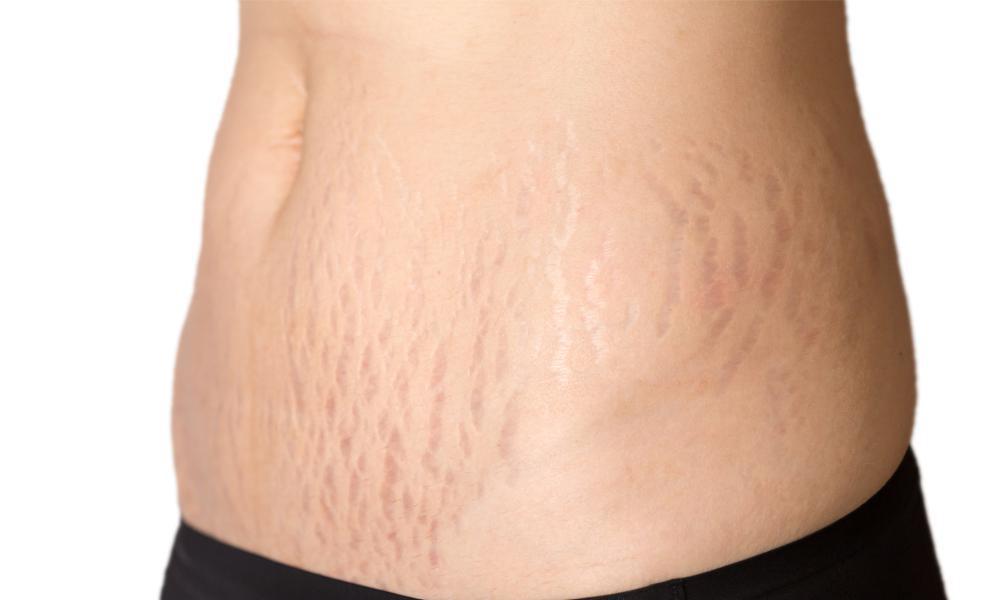 What is the most effective treatment for Stretch Marks? - Ink