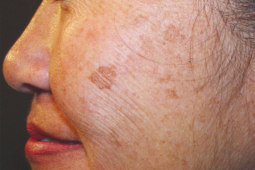 laser treatment for dark spots