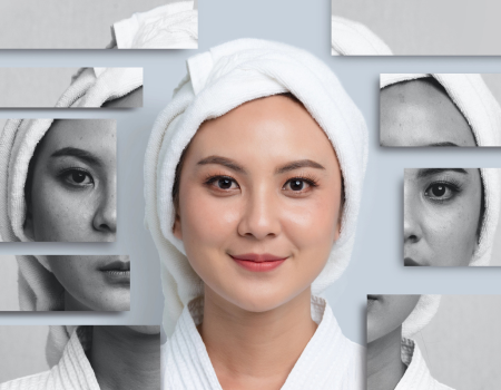 laser skin treatment, melasma